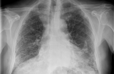 What is Asbestos and why is it dangerous?